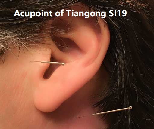 acupuncture Orillia for tinnitus