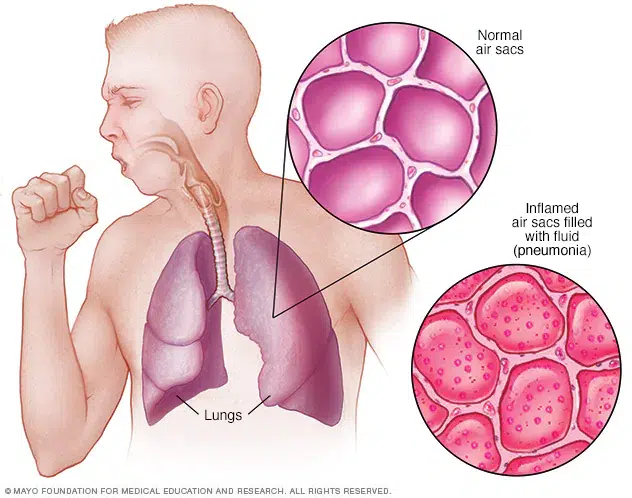 Cindy TCM Acupuncture for 
 Pneumonia