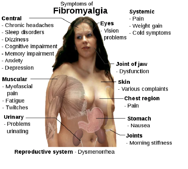 Acupuncture Orillia for fibromyalgia